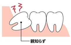 他の歯に悪影響を与えている歯がある